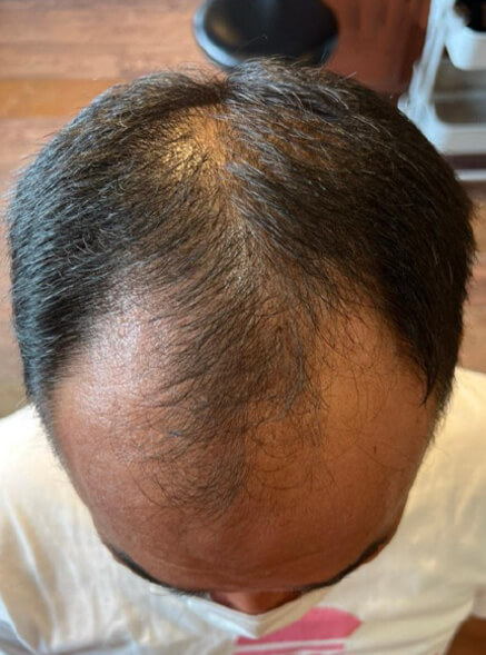 施術事例のBEFORE画像